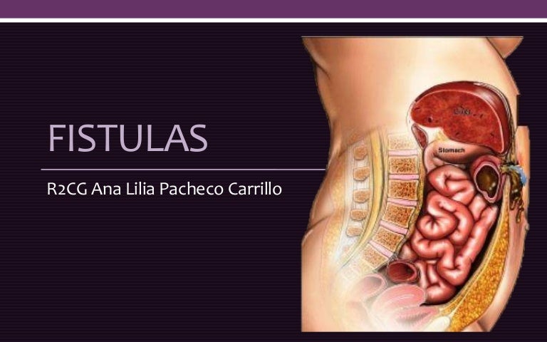 Fistulas fistulas
