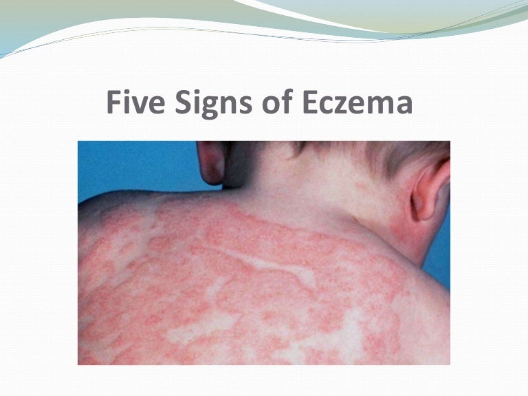 Five Signs of Eczema