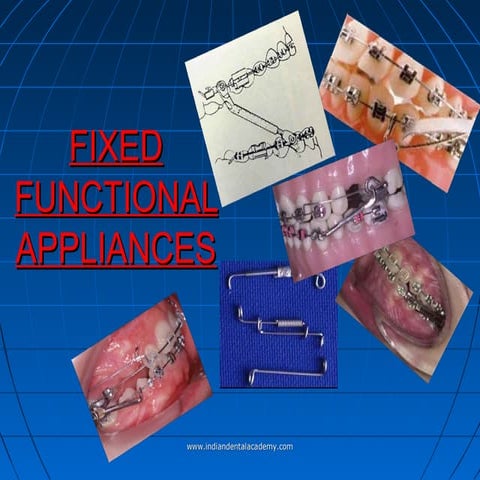 Fixed functional appliances / /certified fixed orthodontic courses by Indian ...