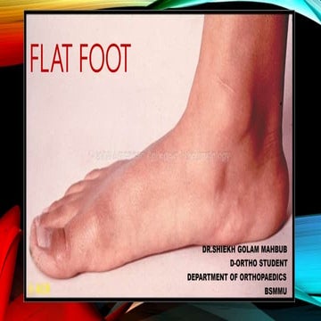 Flat foot By Dr.Mahbub