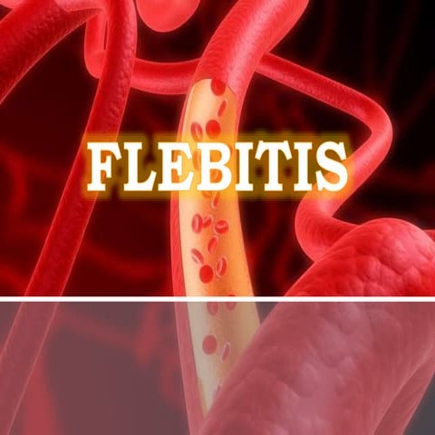 Flebitis | PPTX