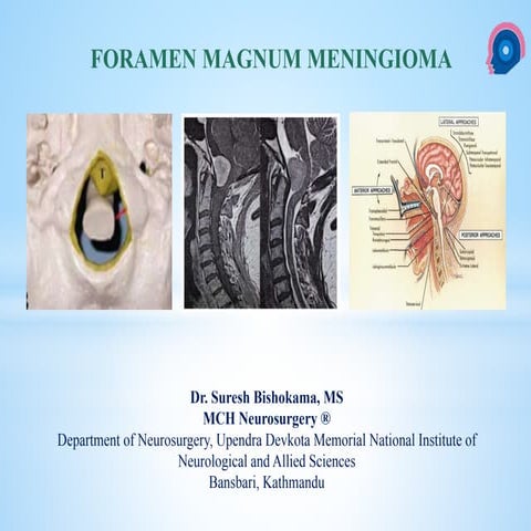 Foramen Magnum Meningioma