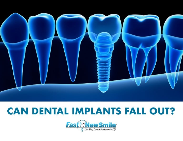 Can dental implants fall out?