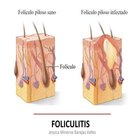 Foliculitis