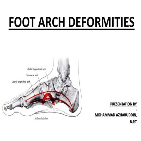 Foot arch deformities 2