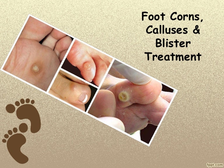 Foot corns, calluses & blister treatment