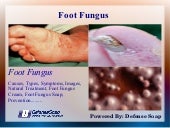 Foot Fungus in Athletes