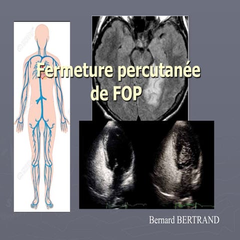 Fermeture Fop Cardiaque _ Fermeture de foramen ovale perméable ou de ...