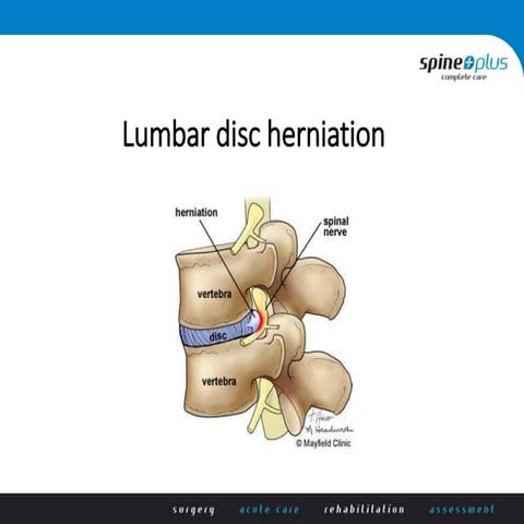 Non-operative management for common back conditions