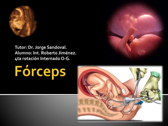 Forceps obstetricia