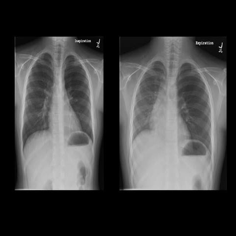 Chest Radiographs | PPT