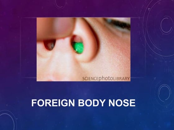 Foreign body in nose by prachi sable .pptx | Ear, Nose and Throat ...