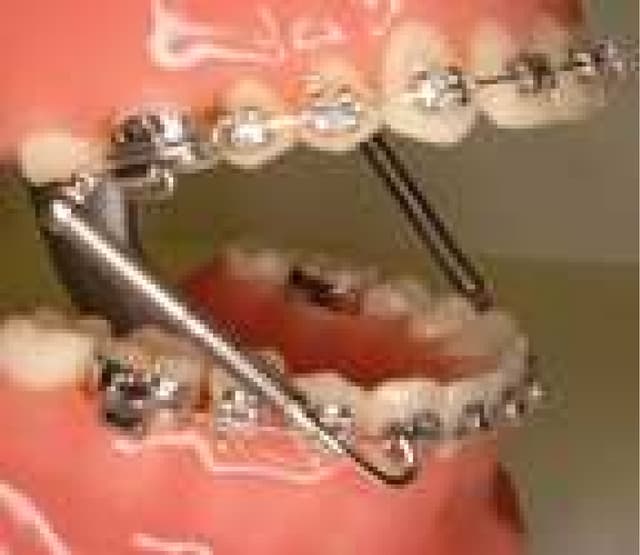 GlauserWilliams Orthodontics Bitesplint