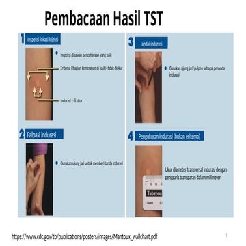 Comprehensive Guide to Reading Tuberculin Skin Test (TST) Results | PPTX