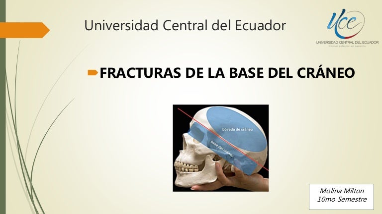 Fractura de base de craneo