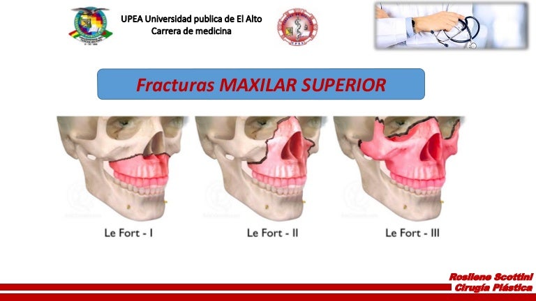 Fractura Maxilar Superior