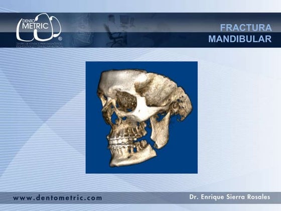 Fractura radicular | PPTX