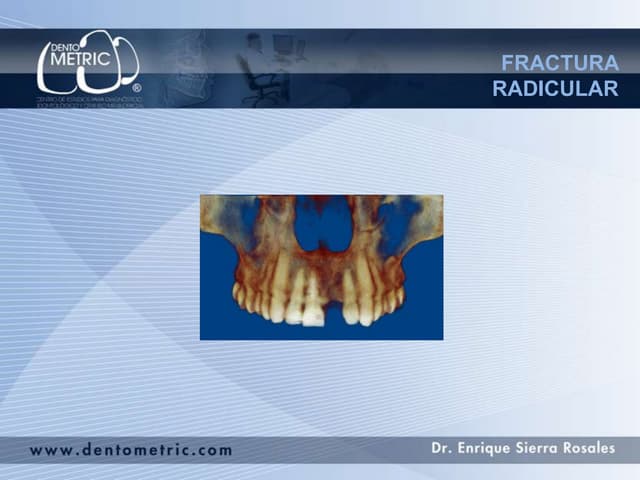Fractura radicular