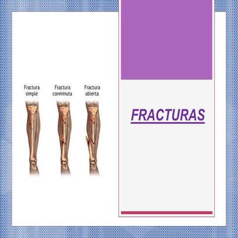 Fracturas