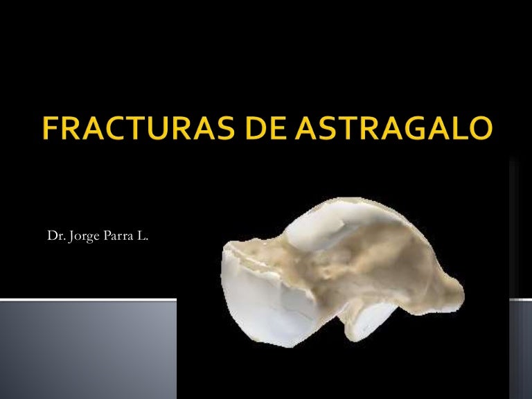 Lesión Del Cartílago Del Astrágalo Fracturas de astragalo