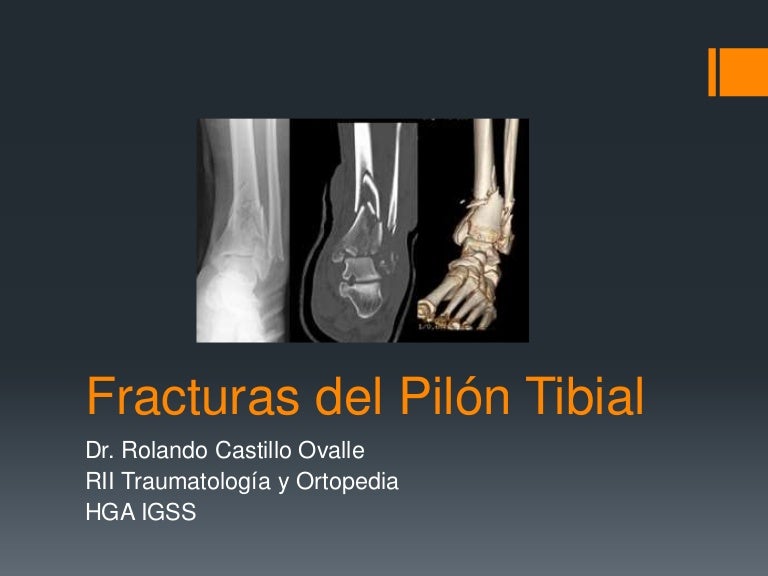 Fracturas de Pilón Tibial