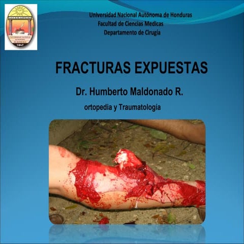 Fracturas expuestas