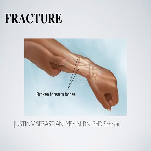 Fracture