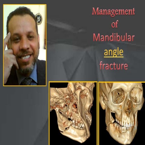 Fracture mandibular angle