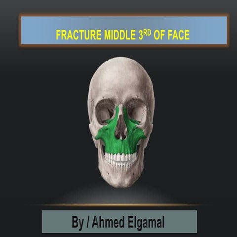 Mid facial fractures ( Mid facial trauma ) | PPTX
