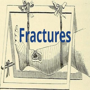 Fracture | PPTX