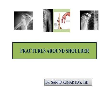Fractures around shoulder