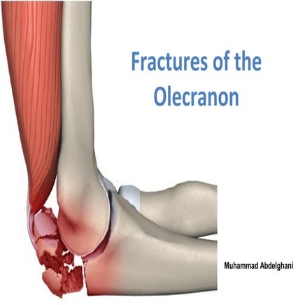 Fractures of the olecranon