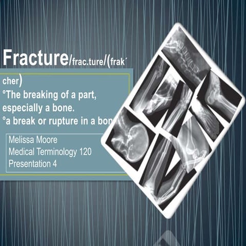 Fractures pesentation 