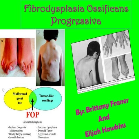 Fibrodysplasia Ossifican Progressiva | PPTX