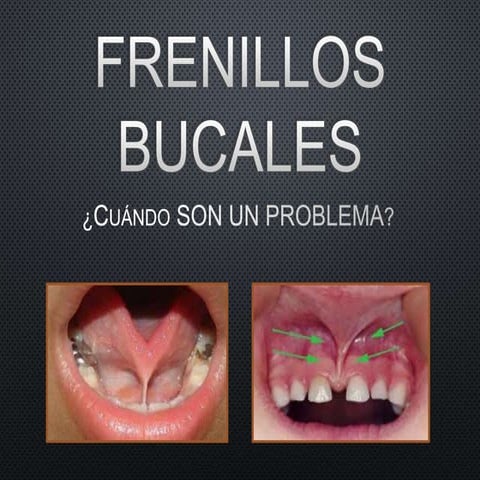 Frenillos Bucales su importancia en  Ortodoncia