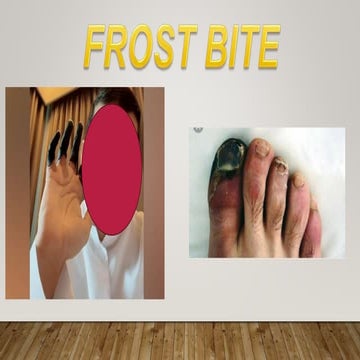 FROSTBITE 