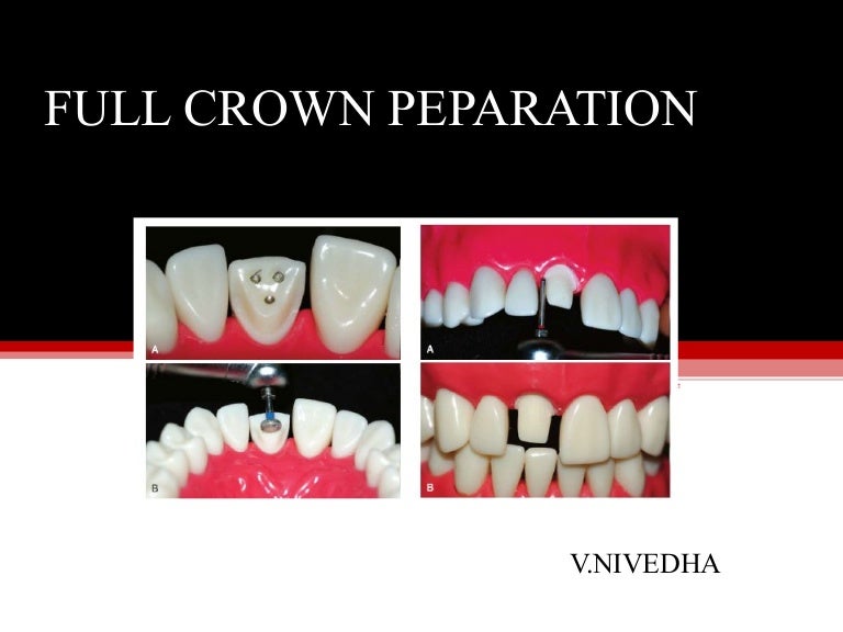 Full crown preparation