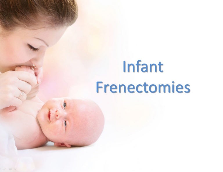 Infant Frenectomies Laser Frenectomy