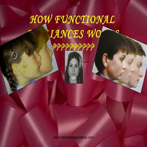 Functional appliances