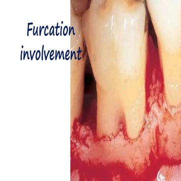 Furcation involvement-periodontology-2.pptx
