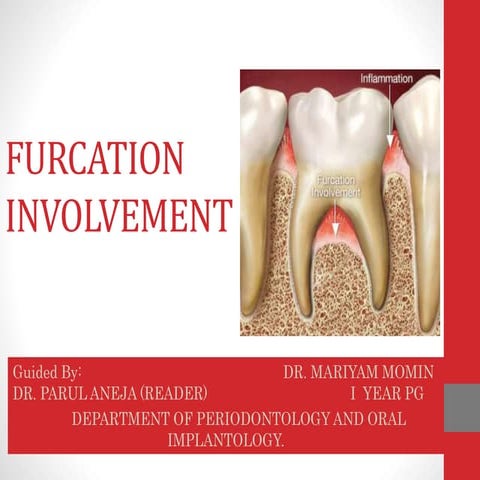 Furcation involvement