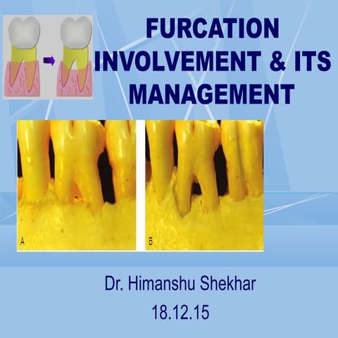Furcation involvement (Dr. Himanshu Shekhar)