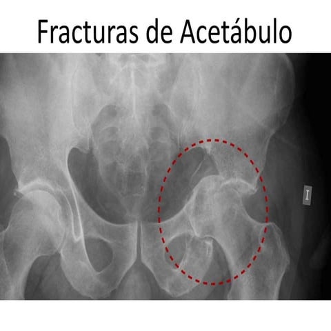 fx acetabulo.pptx