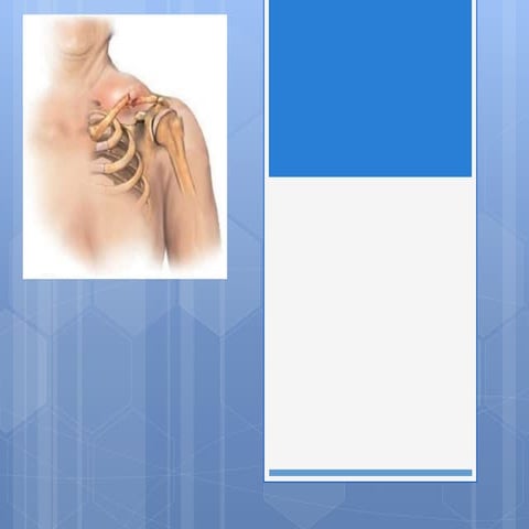 Manejo de fracturas de clavicula tecnica Mc Giver