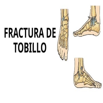 Fracturas de tobillo | PPTX