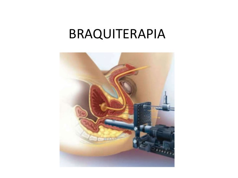 yodo 131 braquiterapia de próstata