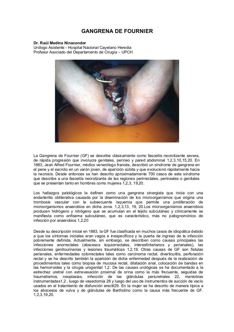 Gangrena de fournier