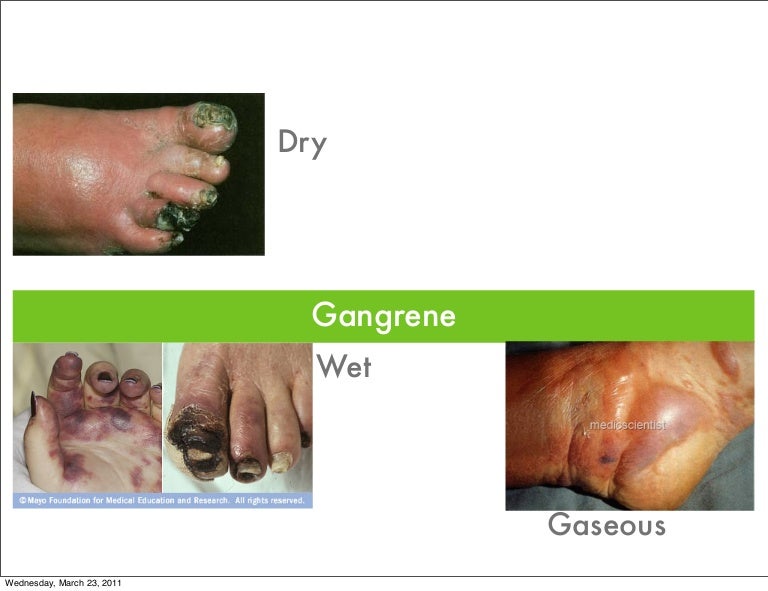 Gangrene symptoms
