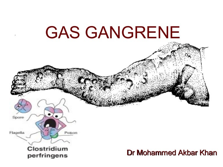 Gas gangrene akbar