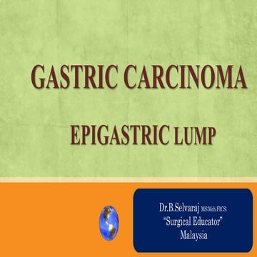 GASTRIC CARCINOMA- EPIGASTRIC LUMPS- Abdominal Lumps.pptx